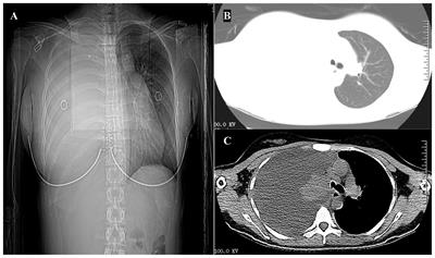 Primary pulmonary nuclear protein of the testis midline carcinoma: case report and systematic review with pooled analysis